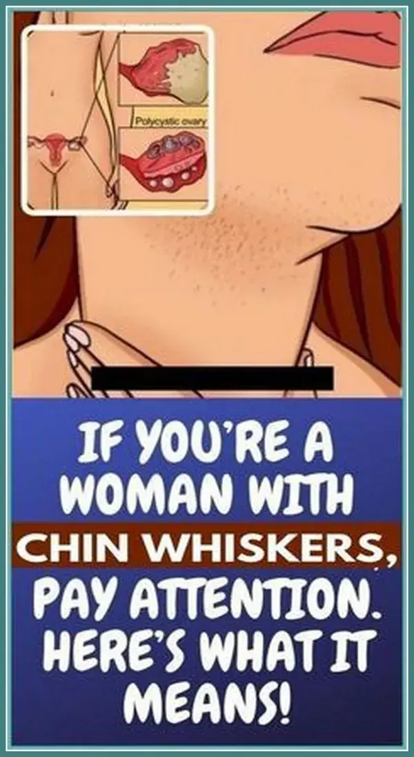 IF YOU�RE A WOMAN WITH CHIN WHISKERS, PAY ATTENTION.