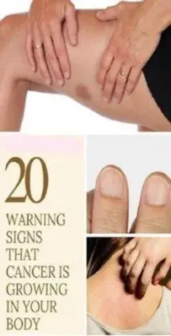 20 WARNING SIGNS THAT CANCER IS GROWING IN YOUR BODY
