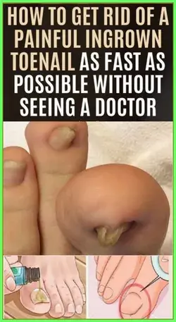 How To Get Rid Of A Painful Ingrain Nail Without a Doctor