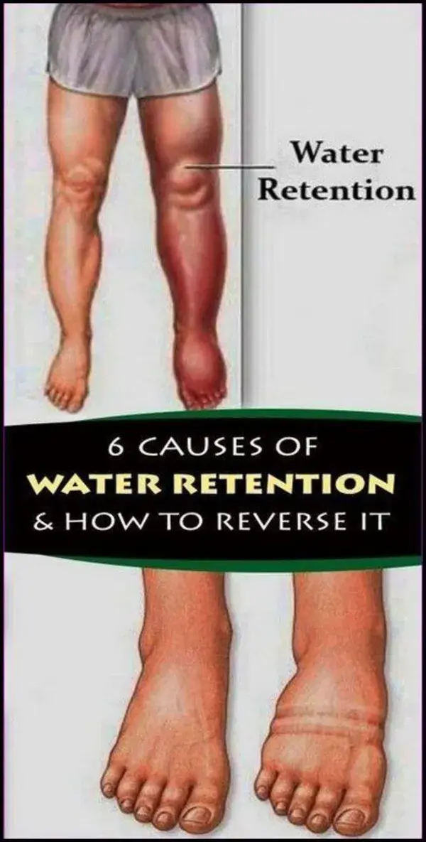 6 CAUSES OF WATER RETENTION AND HOW TO REVERSE IT