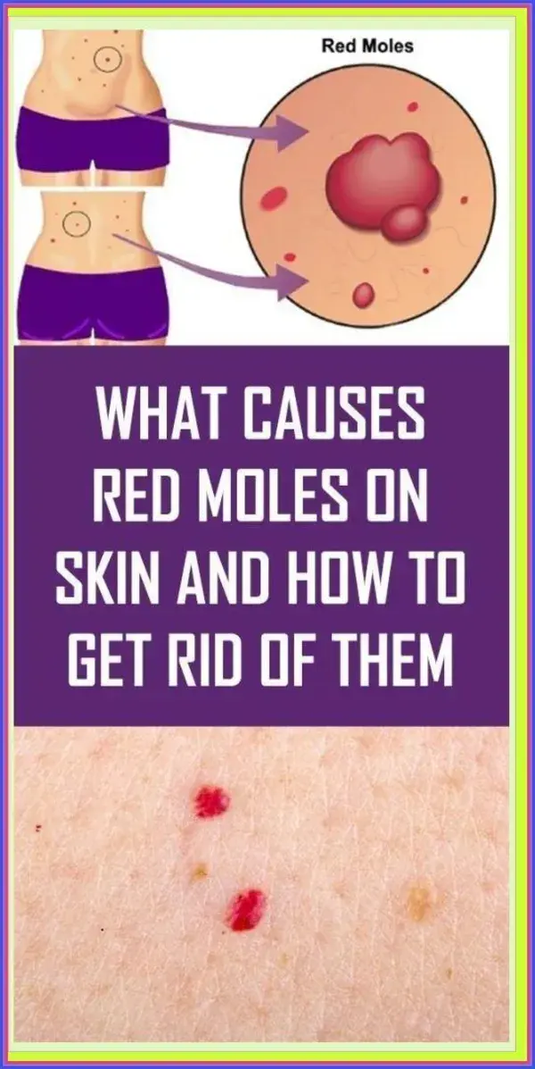 What Do The Red Moles On The Body Mean?