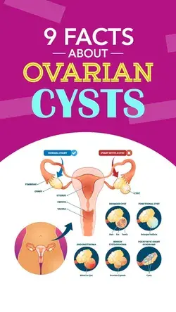 9 Facts About Ovarian Cysts Every Woman Should Know