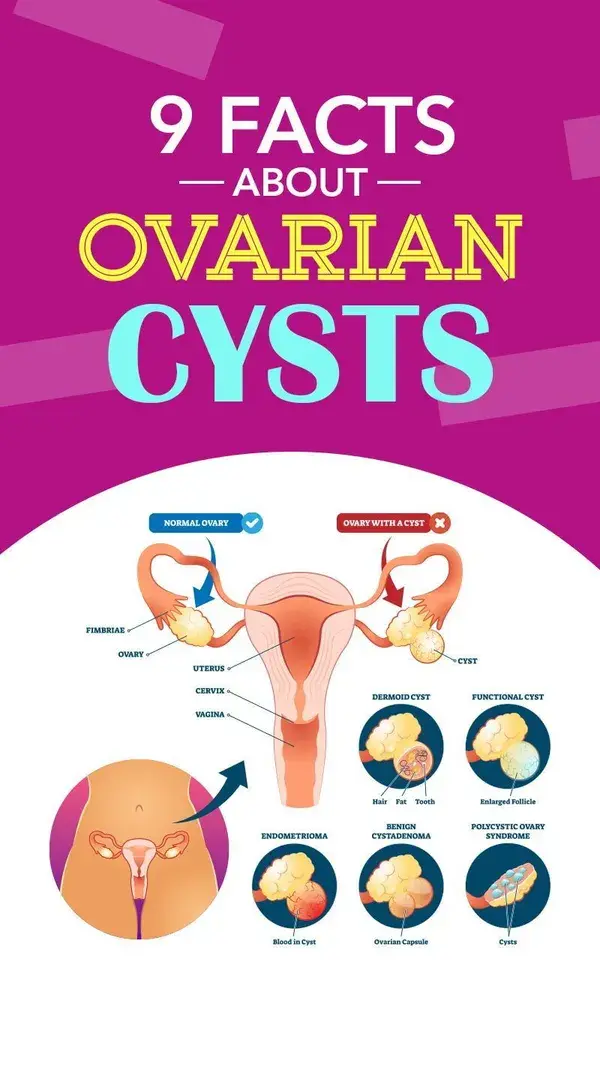 9 Facts About Ovarian Cysts Every Woman Should Know