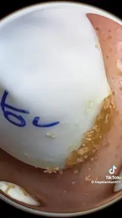 Blackheads Satisfying Removal