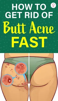 How To Get Rid Of Butt Acne Fast