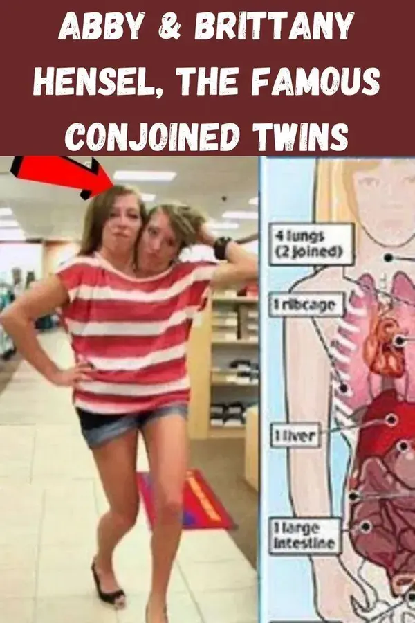 Abby & Brittany Hensel, the Famous Conjoined Twins