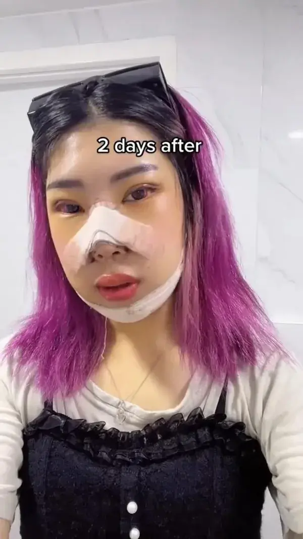 korean plastic surgery post op transformation and recovery