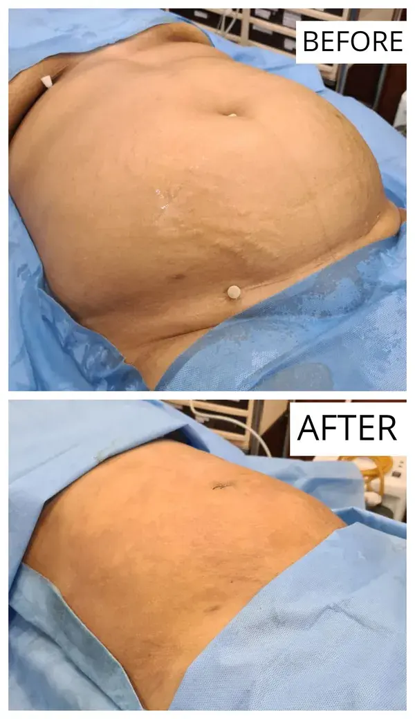 Vaser liposuction