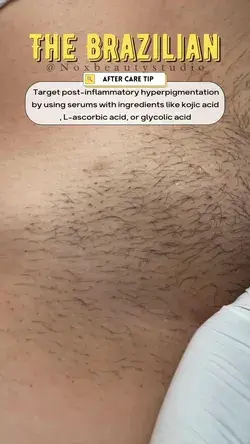 Brazilian Ingrown Hair Treatment