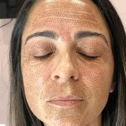 Plasma Láser Facial Completo