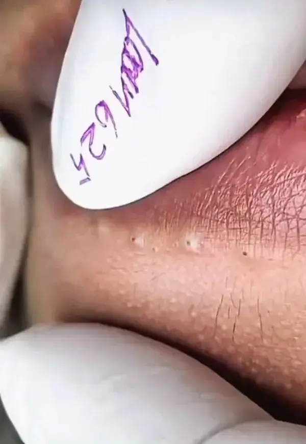 Bottom lips blackhead extraction😍