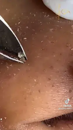 Blackheads removal popping