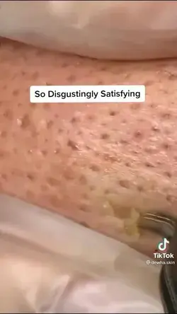 Blackheads popping