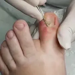 Blackheads removal popping