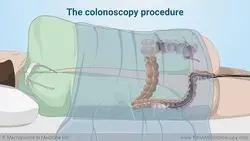 What happens during and after a colonoscopy?