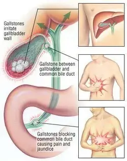 Cholelithiasis Symptoms and Treatment Nurses Note Link👇