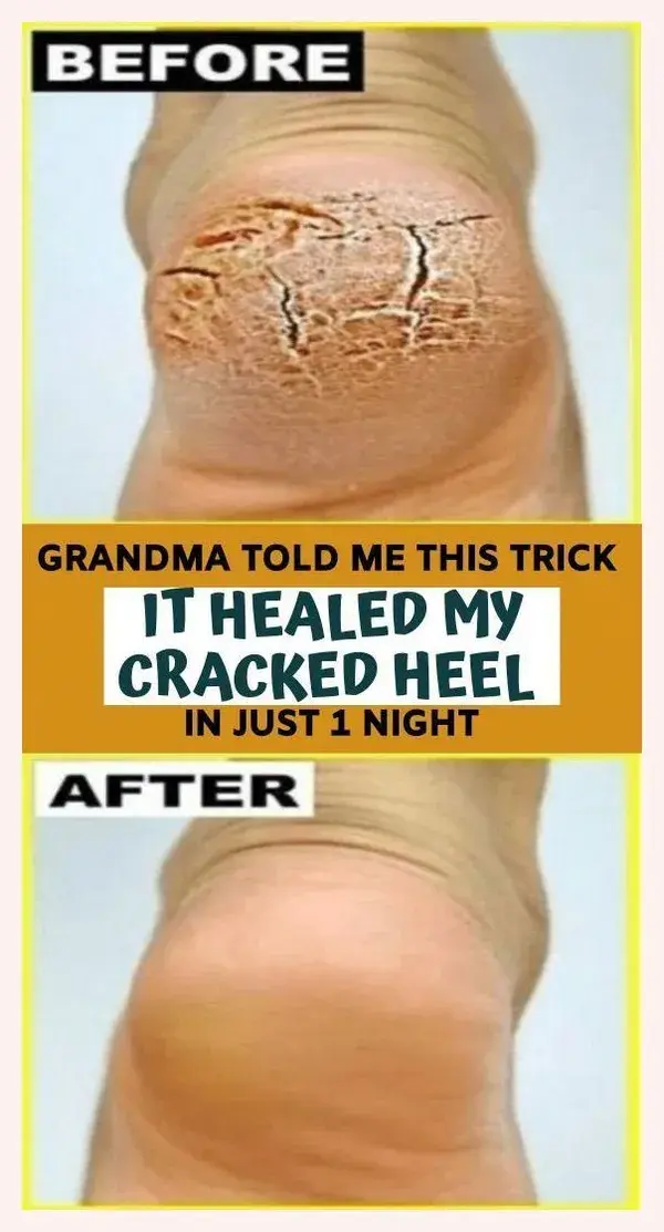 Grandma Told Me This Trick. It Healed My Cracked Heels In Just 1 Night