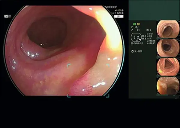 FUJIFILM's AI Colonic Polyp Detector