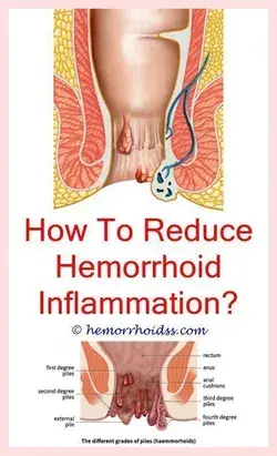 Fastest Removal of Hemorrhoids With These Natural Remedies !