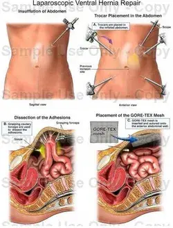 Laparoscopic ventral hernia repair