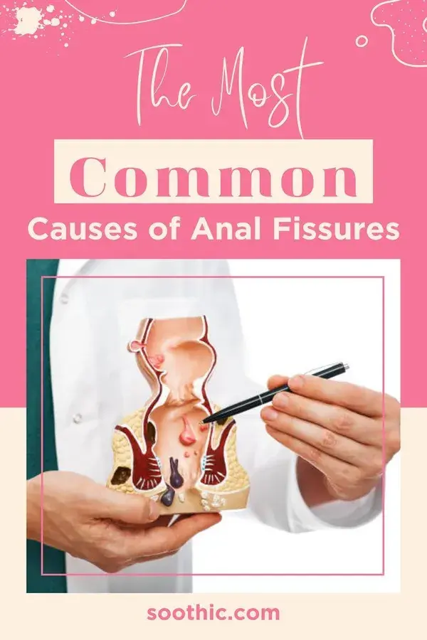 Anal Fissures: What Are the Most Common Causes?