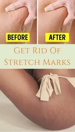 How To Get Rid Of Stretch Marks And Prevent Them Forever