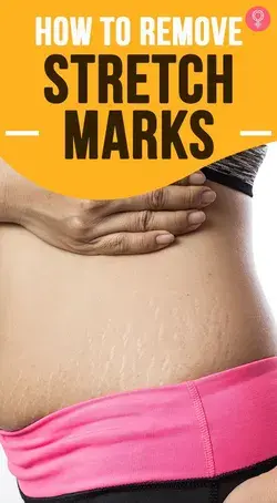 How To Remove Stretch Marks