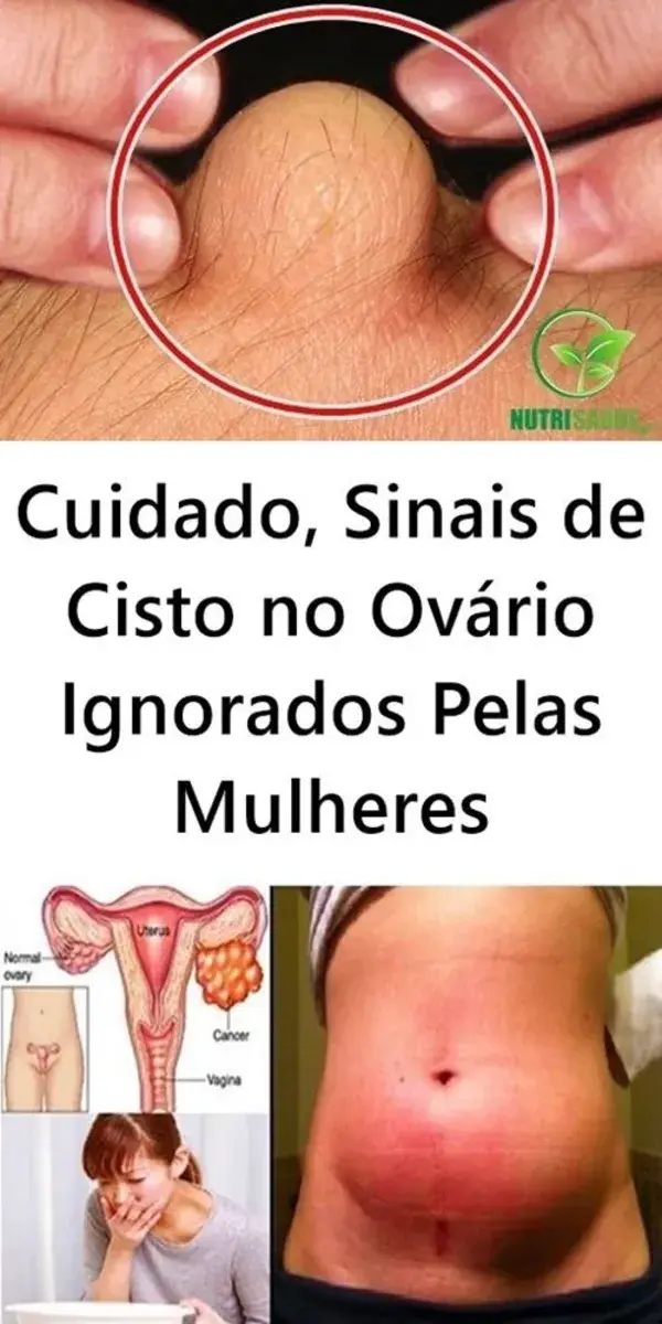 Sinais de Cisto no Ovário Ignorados Pelas Mulheres