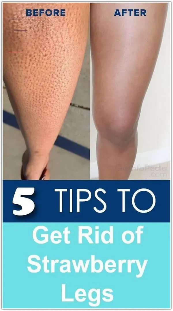 How to Get Rid of Strawberry Legs