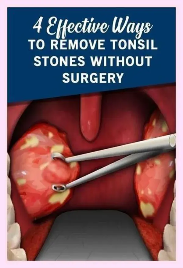 4 Effective Ways to Remove Tonsil Stones Without Surgery