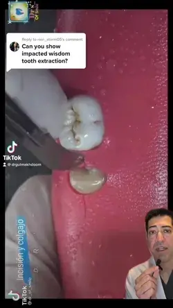 Here is the demonstration of the impacted wisdom tooth extraction on a fake model #wisdomteeth #wis