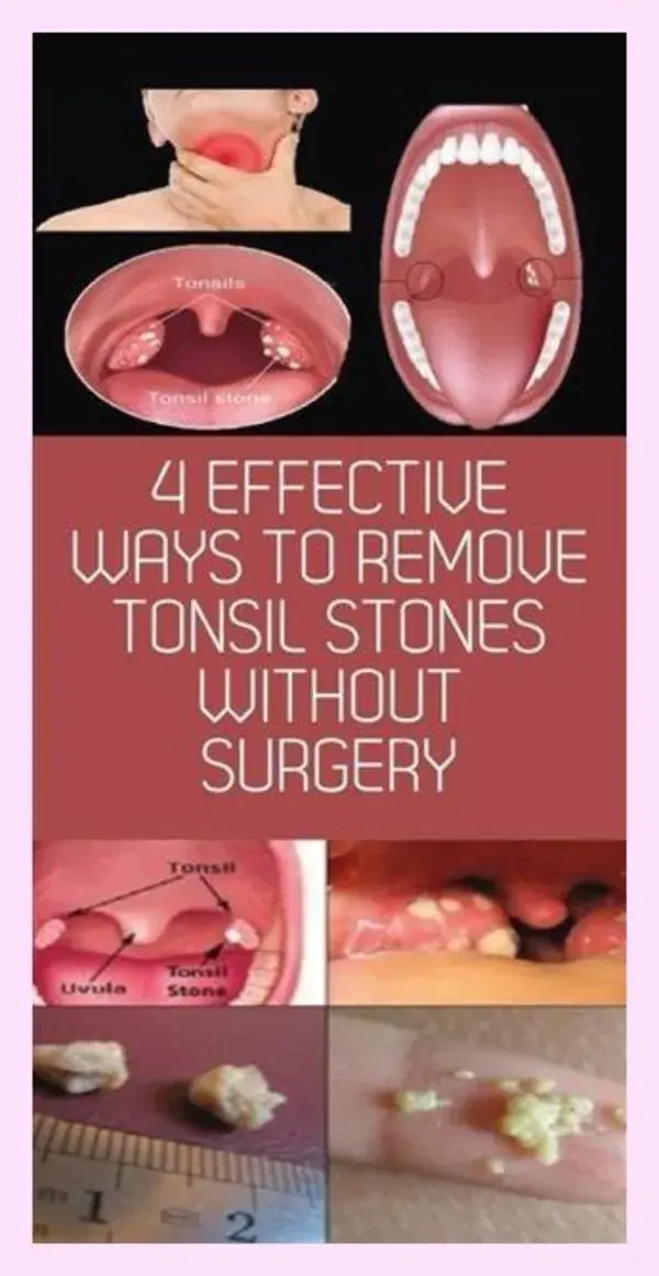 4 Effective Ways to Remove Tonsil Stones Without Surgery