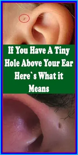 If You Have A Tiny Hole Above Your Ear, Here�s What It Means