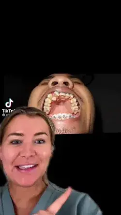 #greenscreenvideo that tooth is done #braces