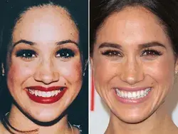 Meghan Markle, Before and After
