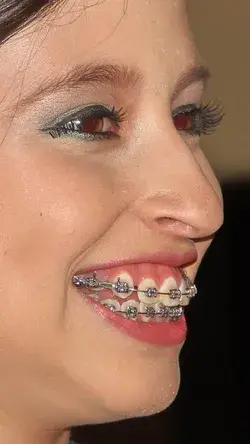 #braces #girlswithbraces #metalbraces
