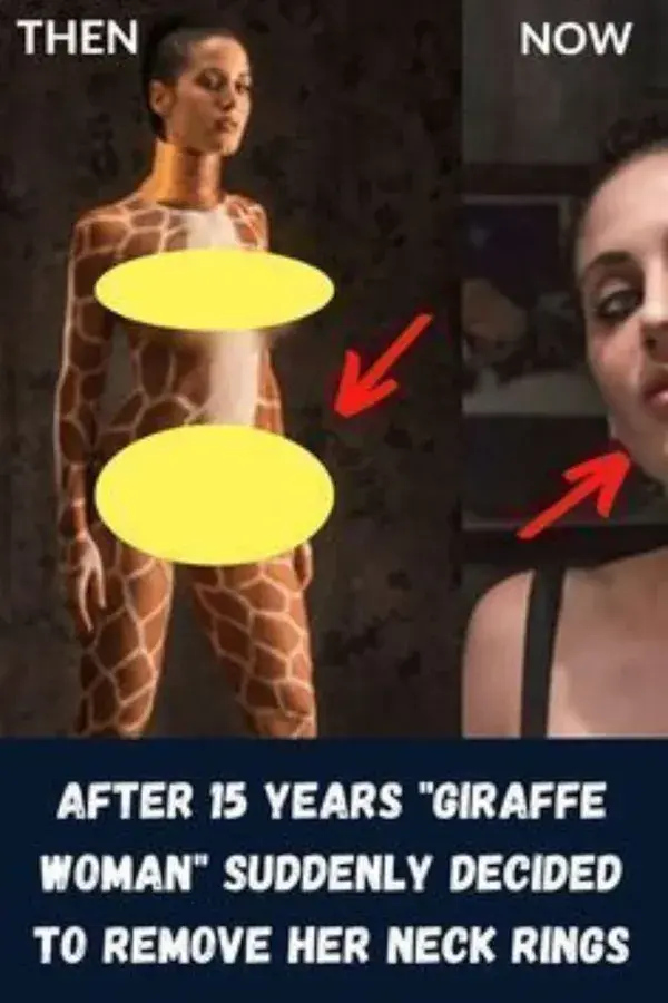 After 15 Years "Giraffe Woman" Suddenly Decided To Remove Her Neck Rings