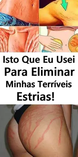 Creme Caseiro Para Eliminar Estrias e Flacidez na Pele!