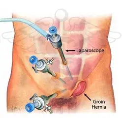 Best Surgery Dr. For Hernia in Brisbane