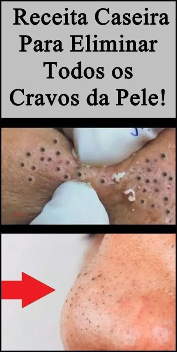 Como tirar cravos do nariz em casa sem acabar