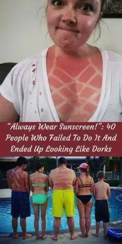 “Always Wear Sunscreen!”: 40 People Who Failed To Do It And Ended Up Looking Like Dorks