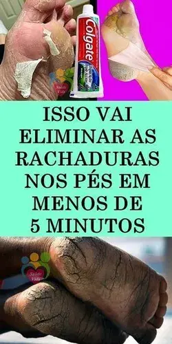 Receita Caseira Para Tratar Pés Rachados, com Fissuras e Ressecados!