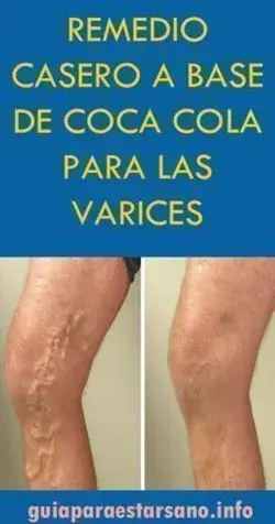 1 crema para curar tus vérices de forma permanente y natural.