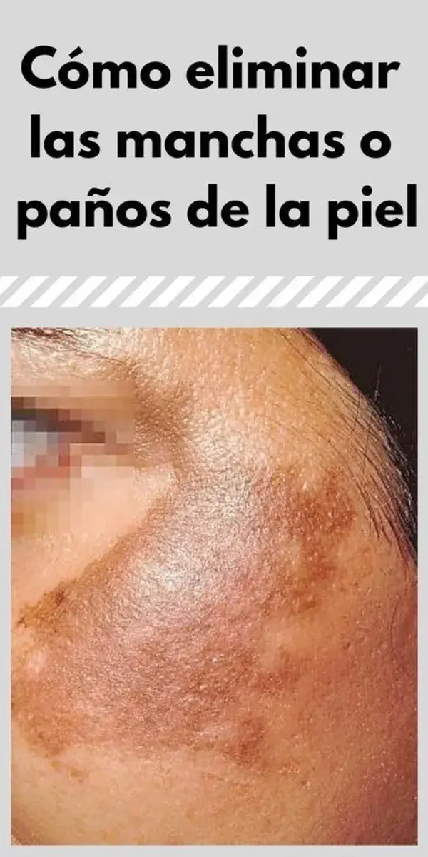 Elimine las manchas en su cara en solo 3 noches, con este remedio casero