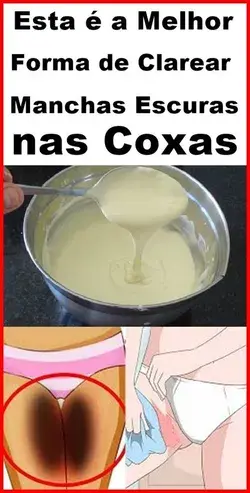 Receita Caseira Para Clarear Manchas Escuras nas Coxas!