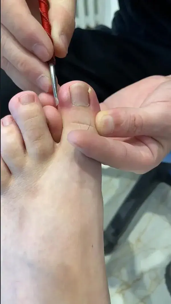 satisfying toenail cleaning #ingrown #toenail #ingrownremoval