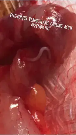 Enterobius vermicularis causing acute appendicitis