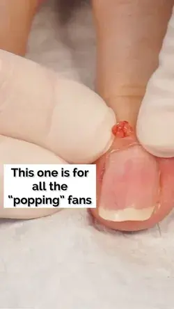 Popping a cyst on finger