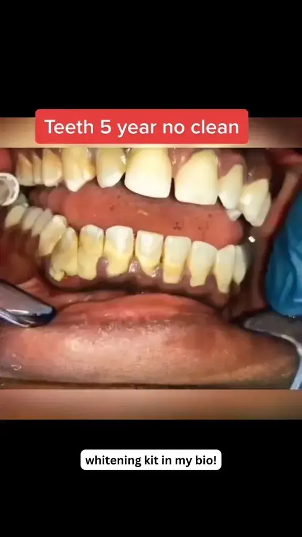 Teeth cleaning after 5 years