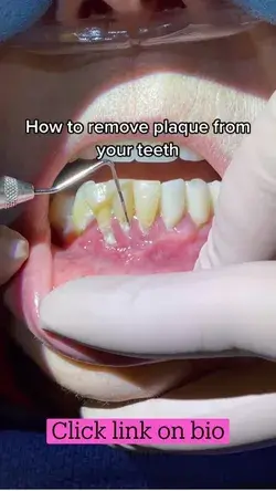 How to remove plaque from your teeth